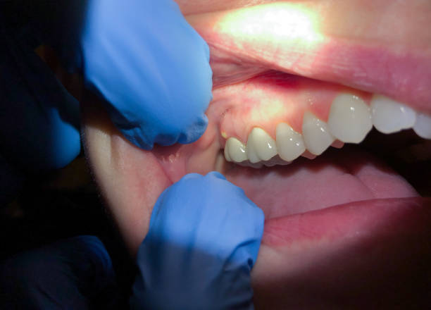 Best Emergency Dental Care for Abscessed Tooth in Allardt, TN